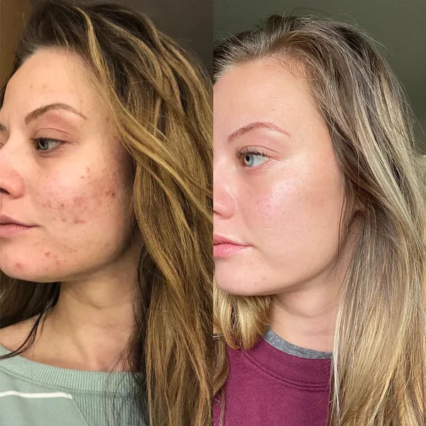before after skin.webp__PID:7885654d-ec37-4819-a24d-9984e1042e87